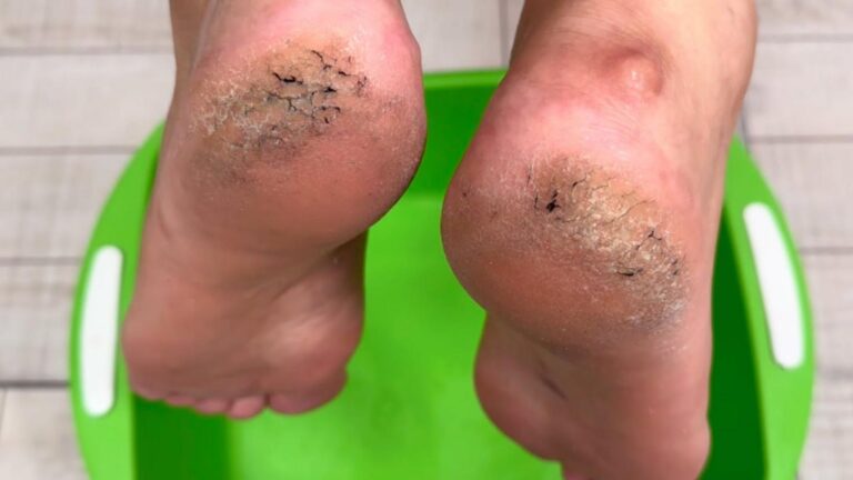 Questo trucco dimenticato renderà i tuoi talloni morbidi come quelli di un bambino…
