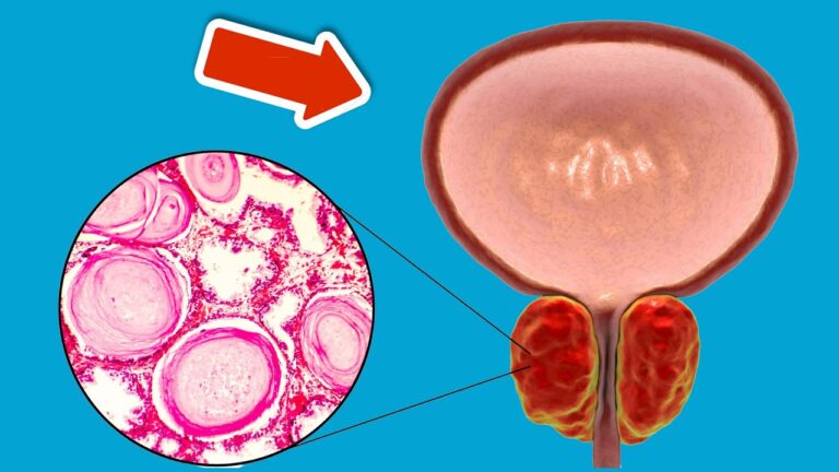 6 alimenti per una prostata sana che devi assolutamente conoscere