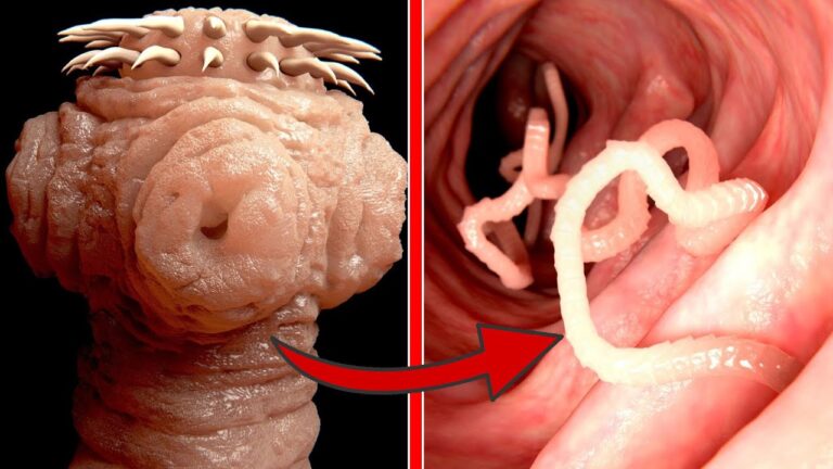Scopri 5 metodi semplici per liberarti dei parassiti intestinali!