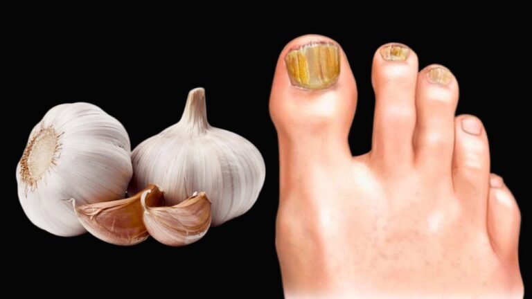 5 rimedi naturali contro il piede d’atleta con il potere dell’aglio!